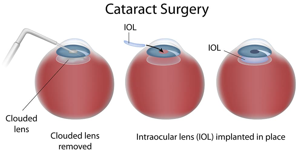 Cataract Surgery Diagram