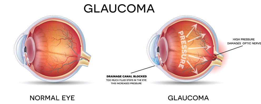 Glaucoma Diagram