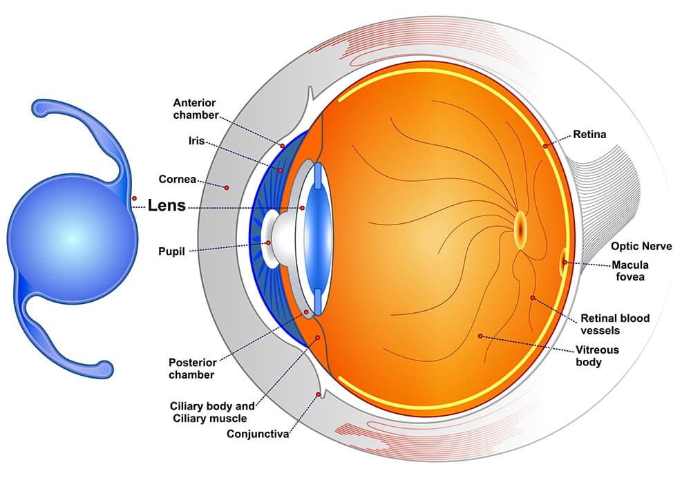 Diagram of IOL