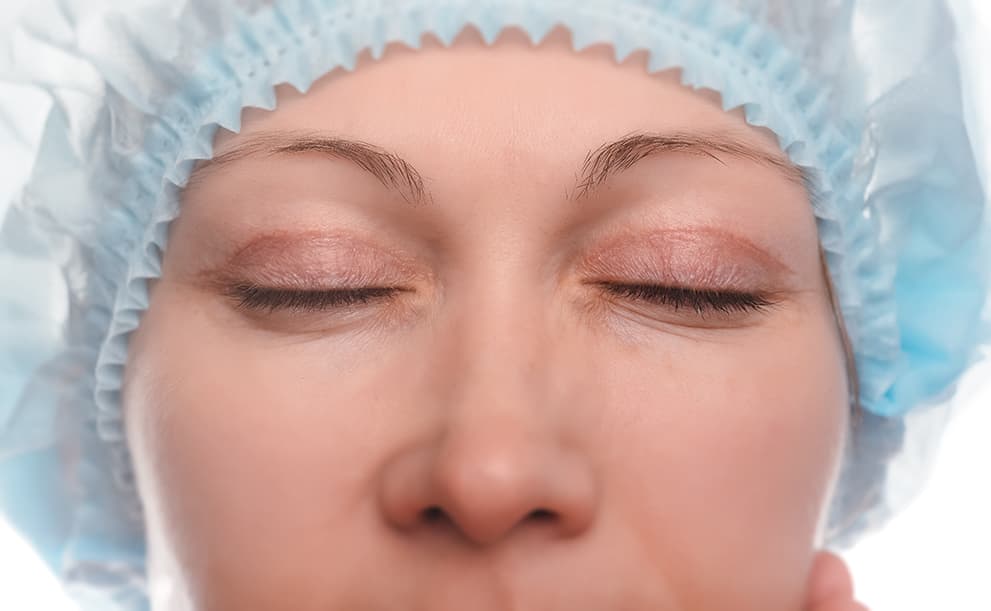 upper eyelid surgery